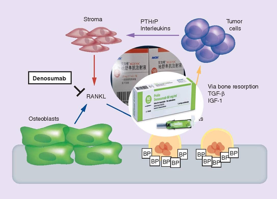  地舒單抗在慢性腎臟疾病中的骨保護作用